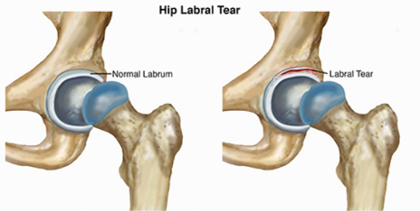 Quality T-Scope Hip Brace for Optimal Recovery Support