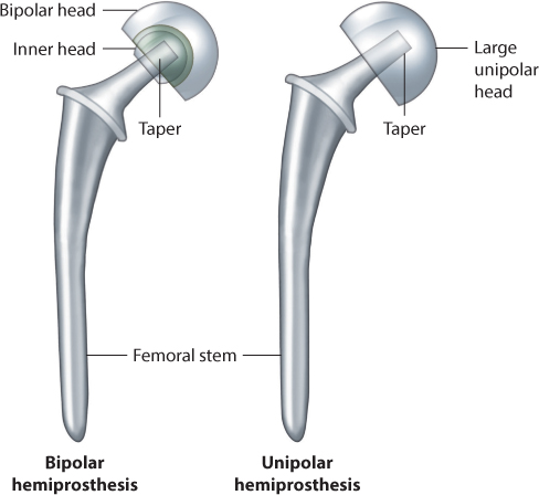 Why Partial Hip Replacements Fail and Determining when It’s Time to ...