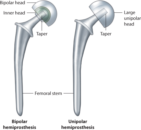 Cemented hip replacement improves quality of life for patients