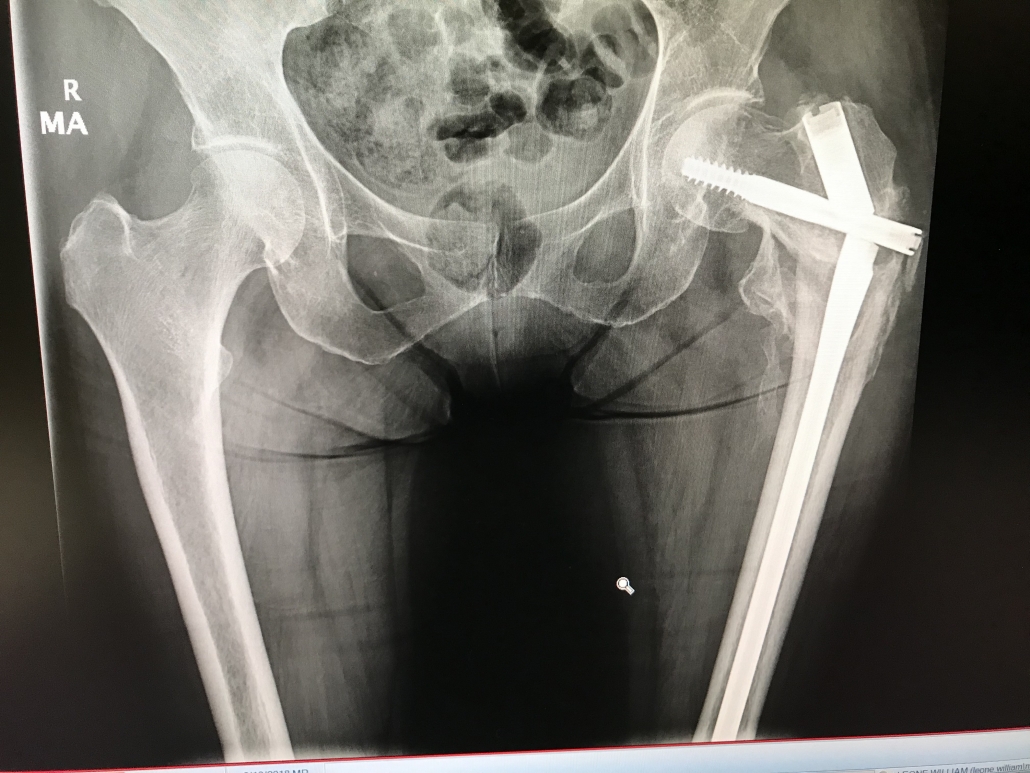 Can a hip fracture heal without surgery?