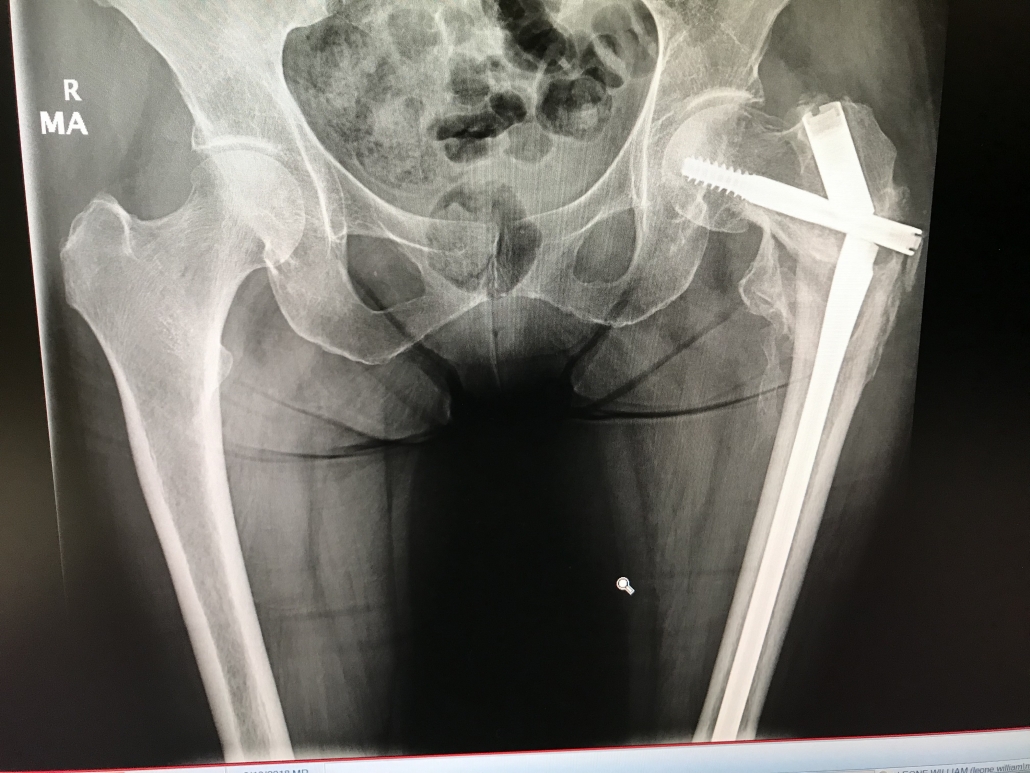 xray of normal hip replacement