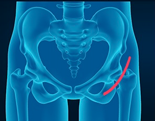 Advantages and Disadvantages of Anterior Hip Replacement