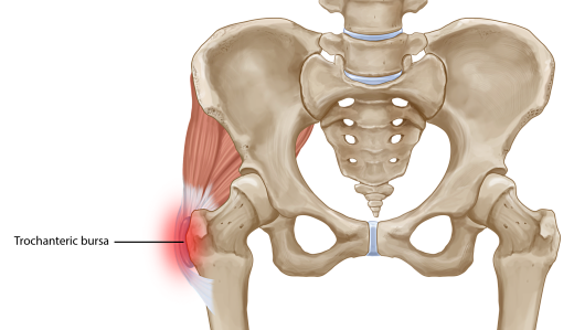 Greater Trochanteric Bursitis: A Common Cause of Hip Pain - The Leone Center for Orthopedic Care