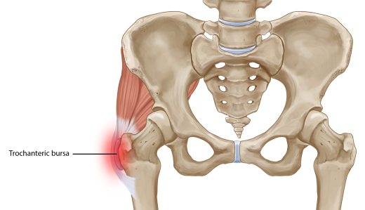 Exercise Tips for Hip (Trochanteric) Bursitis - Scolio-Pilates