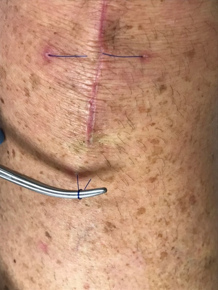 Use of a Subcuticular Suture to Close Hip and Knee Incisions and