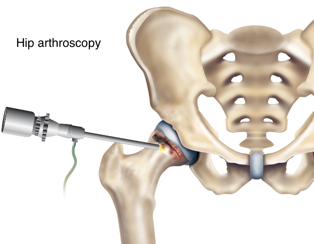 What is Hip Arthroscopy? Procedure & Recovery