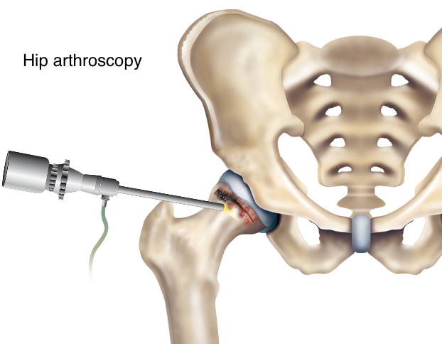 When is Hip Arthroscopy an Effective Course of Treatment? - The