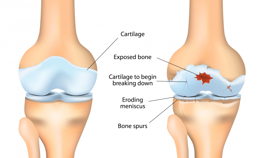 Osteoarthritis of the ankle: methods for joint-preservation