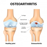 osteoarthritis, Stem Cell injections