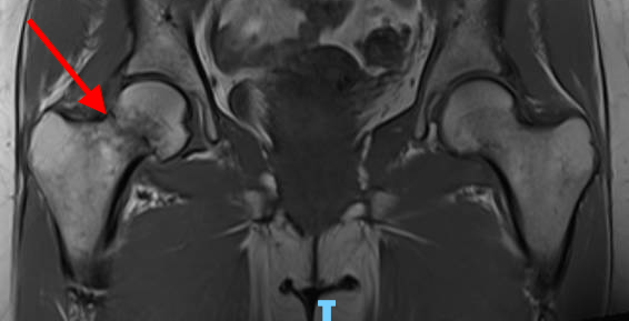 Groin Pain After Hip Pinning