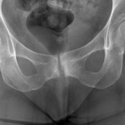 hip replacement or fracture
