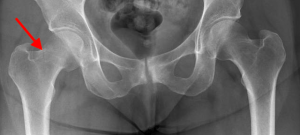 hip replacement or fracture