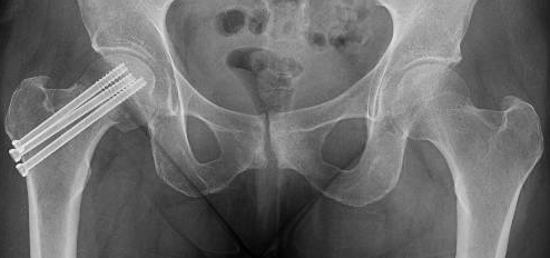 Neck Pinning Roids Groin Pain After Hip Pinning