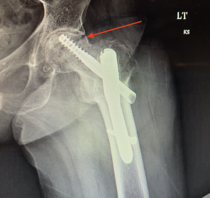 Groin Pain After Hip Pinning